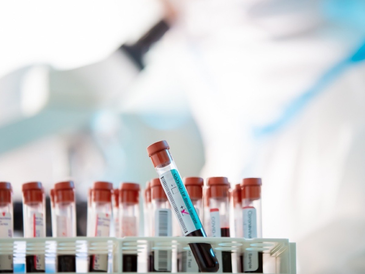 A rack of collected blood sample tubes ready for processing — lab testing for Mission patients