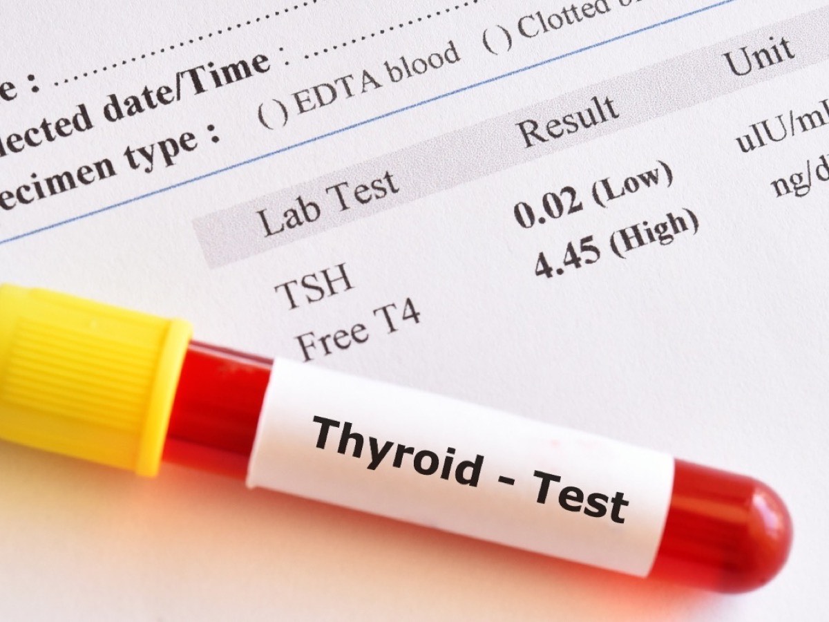 A labelled thyroid test blood sample tube resting on a result form